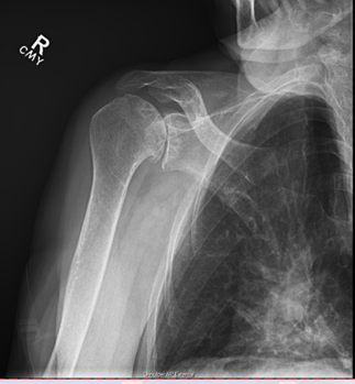 Shoulder Before Replacement Surgery