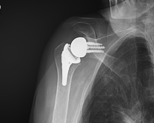 Shoulder After Replacement Surgery